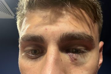 🤯 Fenerbahçe-Galatasaray, derby dalle mille polemiche: “L’occhio di Karatas quasi accecato”