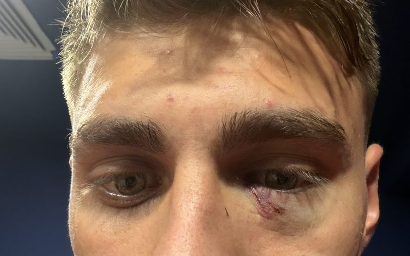 🤯 Fenerbahçe-Galatasaray, derby dalle mille polemiche: “L’occhio di Karatas quasi accecato”