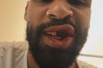 📸 Loftus SHOCK dopo lo scontro con Corvi: l’inglese pubblica il suo volto su IG 😳