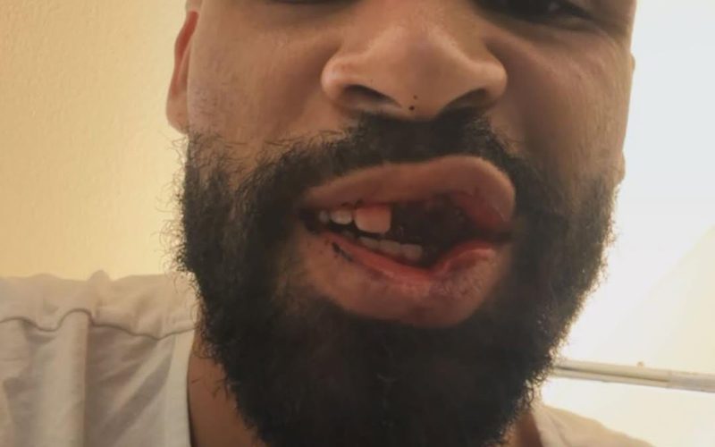 📸 Loftus SHOCK dopo lo scontro con Corvi: l’inglese pubblica il suo volto su IG 😳